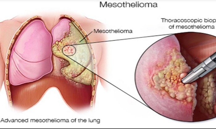 symptoms of mesothelioma in women